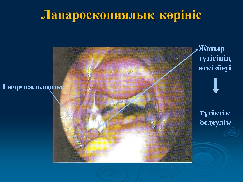 Лапароскопиялық көрініс Гидросальпинкс Жатыр түтігінің өткізбеуі Түтіктік  бедеулік